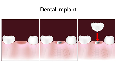 Gravesend Dental Implants